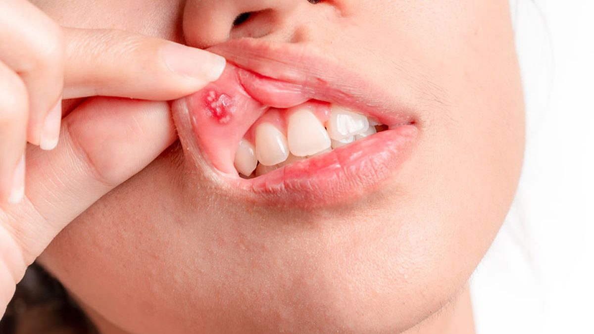 Afte in bocca: rimedi e come eliminarle. Donna mostra afta sul labbro superiore.