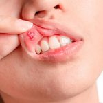 Afte in bocca: rimedi e come eliminarle. Donna mostra afta sul labbro superiore.