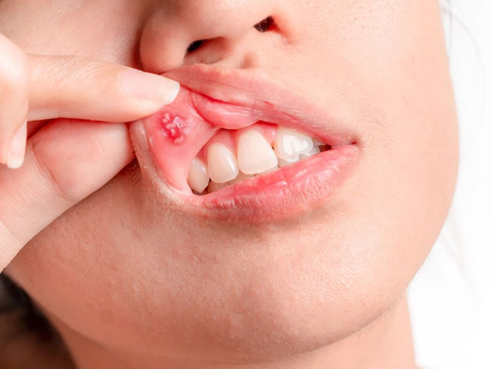 Afte in bocca: rimedi e come eliminarle. Donna mostra afta sul labbro superiore.