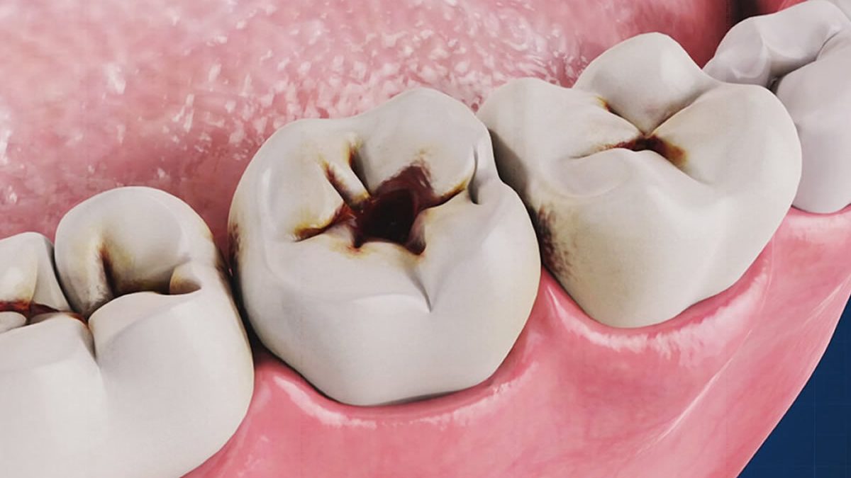 Denti con carie. Immagine ravvicinata di denti cariati. Cura e prevenzione della carie dentale.