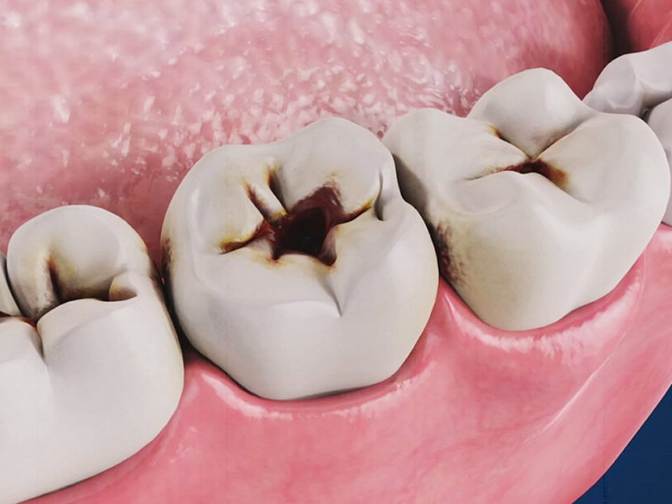 Denti con carie. Immagine ravvicinata di denti cariati. Cura e prevenzione della carie dentale.