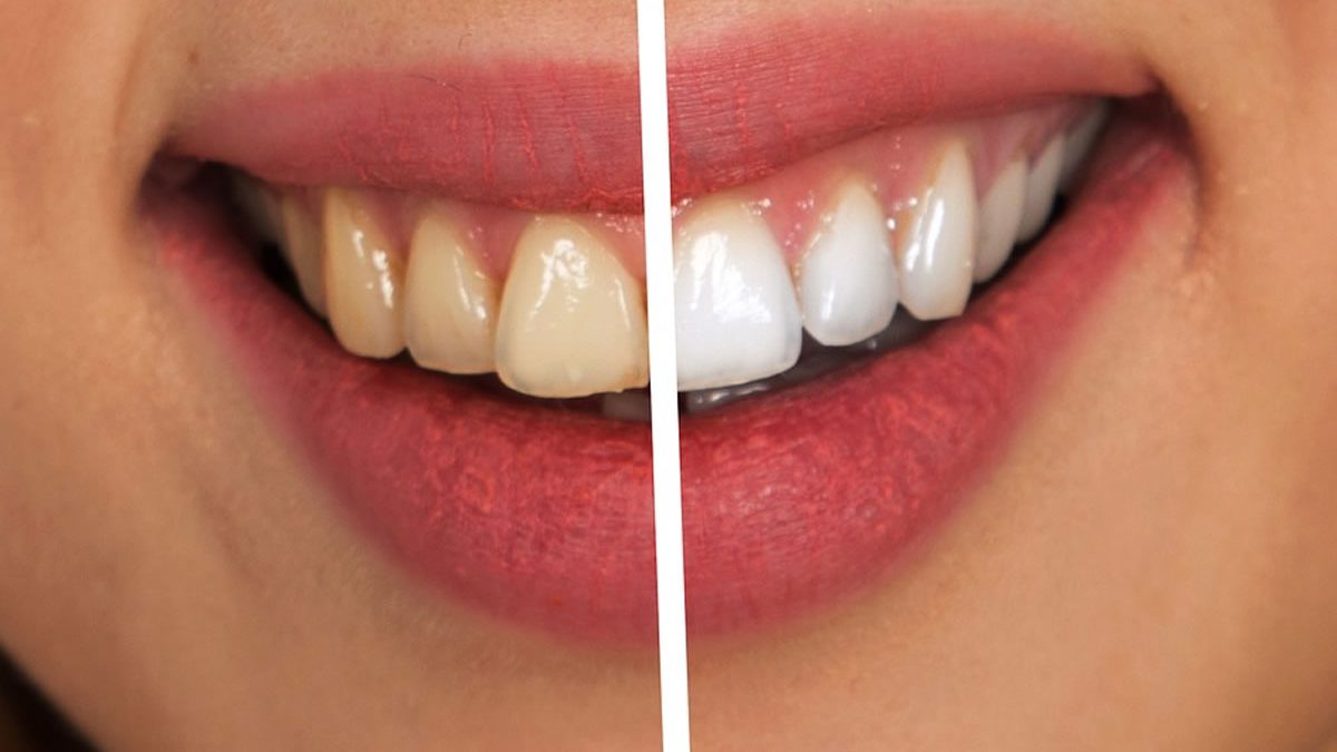 Risultati dello sbiancamento dentale: confronto prima e dopo per un sorriso più bianco e luminoso.