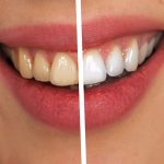 Risultati dello sbiancamento dentale: confronto prima e dopo per un sorriso più bianco e luminoso.