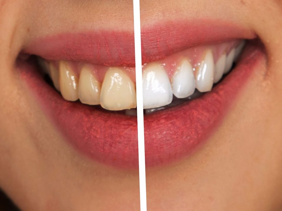 Risultati dello sbiancamento dentale: confronto prima e dopo per un sorriso più bianco e luminoso.