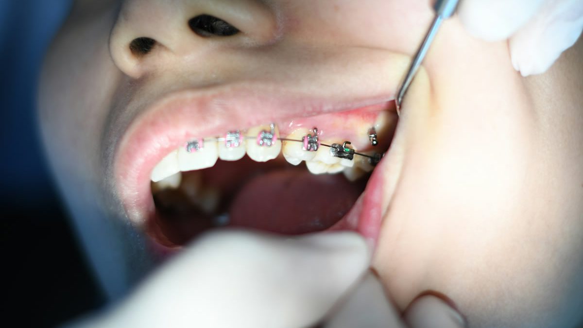 Paziente ortodontico a Piacenza con apparecchio dentale. Controllo dal dentista.