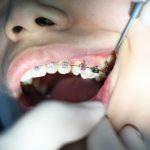 Paziente ortodontico a Piacenza con apparecchio dentale. Controllo dal dentista.
