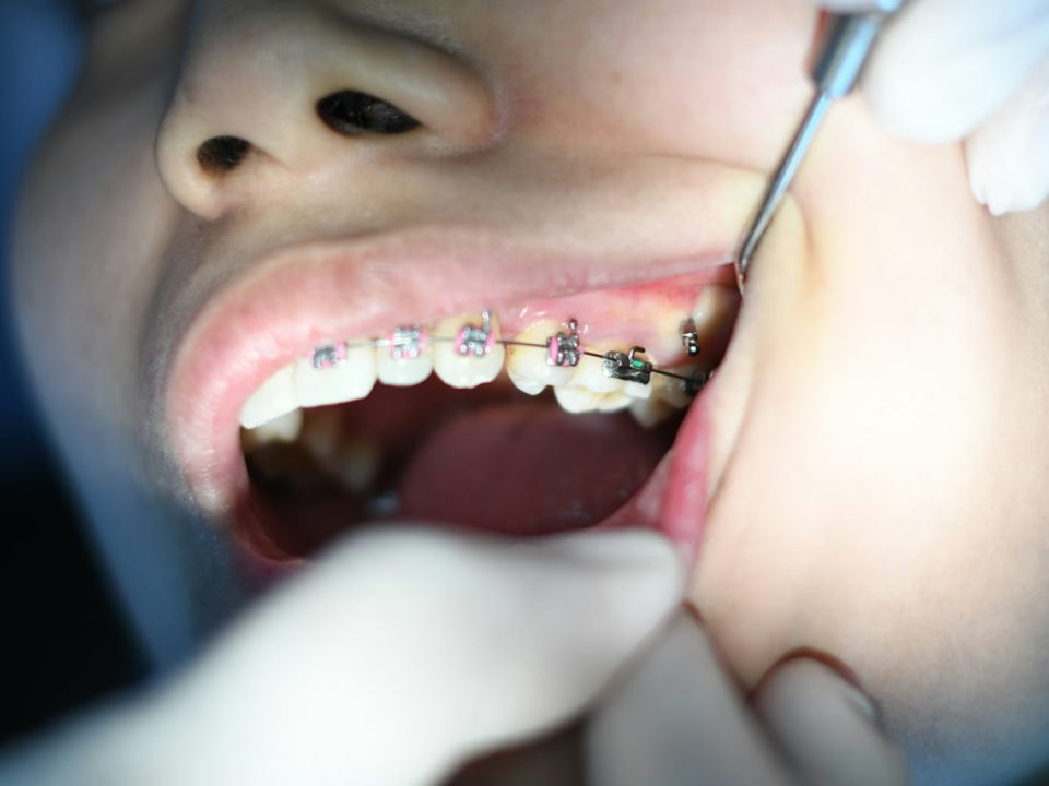 Paziente ortodontico a Piacenza con apparecchio dentale. Controllo dal dentista.