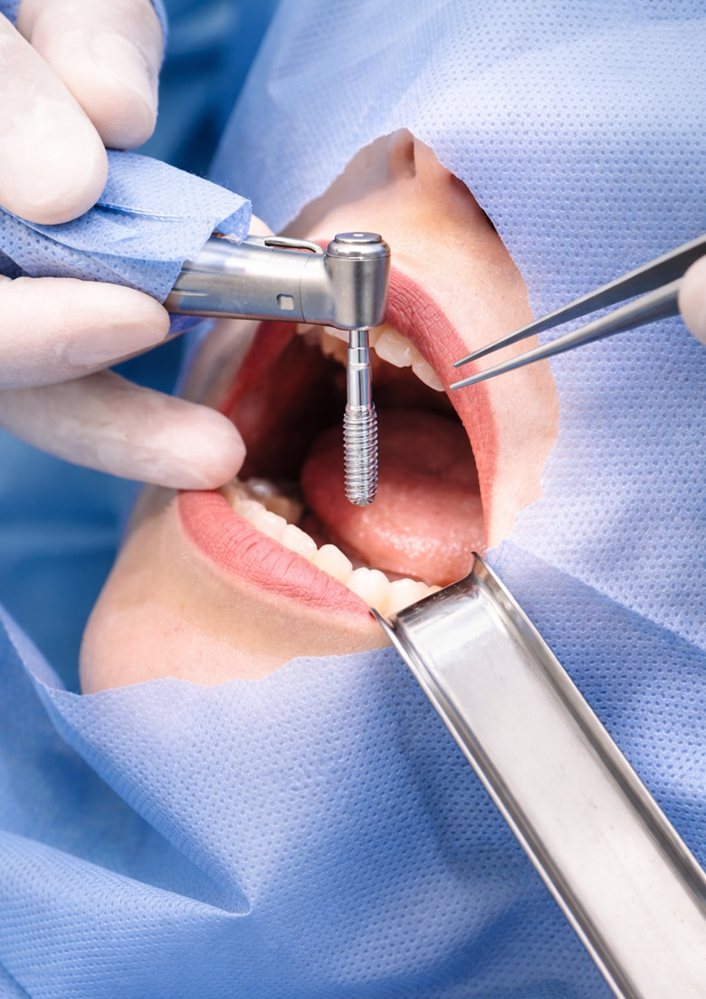 Implantologia a Piacenza e Lodi: chirurgia orale avanzata per un sorriso perfetto e duraturo.