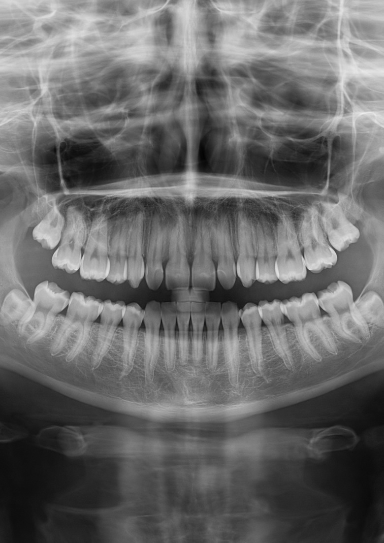 Radiografia Cone Beam a Piacenza e Lodi: visualizzazione dentale completa per diagnosi precise.