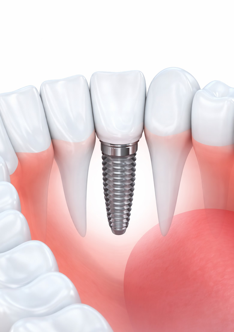 Implantologia dentale Piacenza e Lodi: impianto dentale per un sorriso perfetto e duraturo.