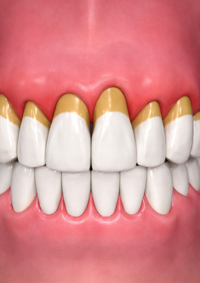 Parodontologia Piacenza Lodi: gengive infiammate e tartaro. Cura e prevenzione per un sorriso sano.